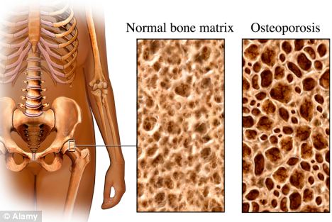 Osso normal X osso osteoporótico mostrando a fragilidade e a razão das fraturas que muitas vezes ocorrem espontaneamente.