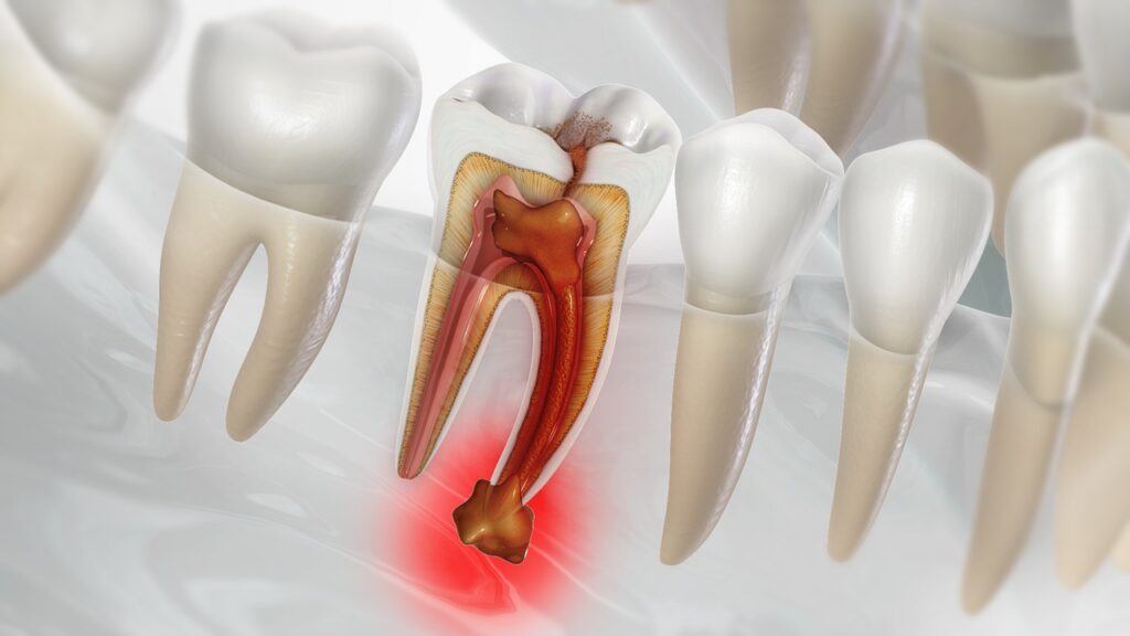 Abcesso dentário em dente molar inferior causado pela necrose da polpa dental.