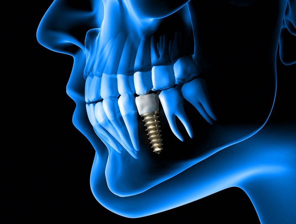 Implantes dentários são a melhor forma de substituir dentes perdidos. 